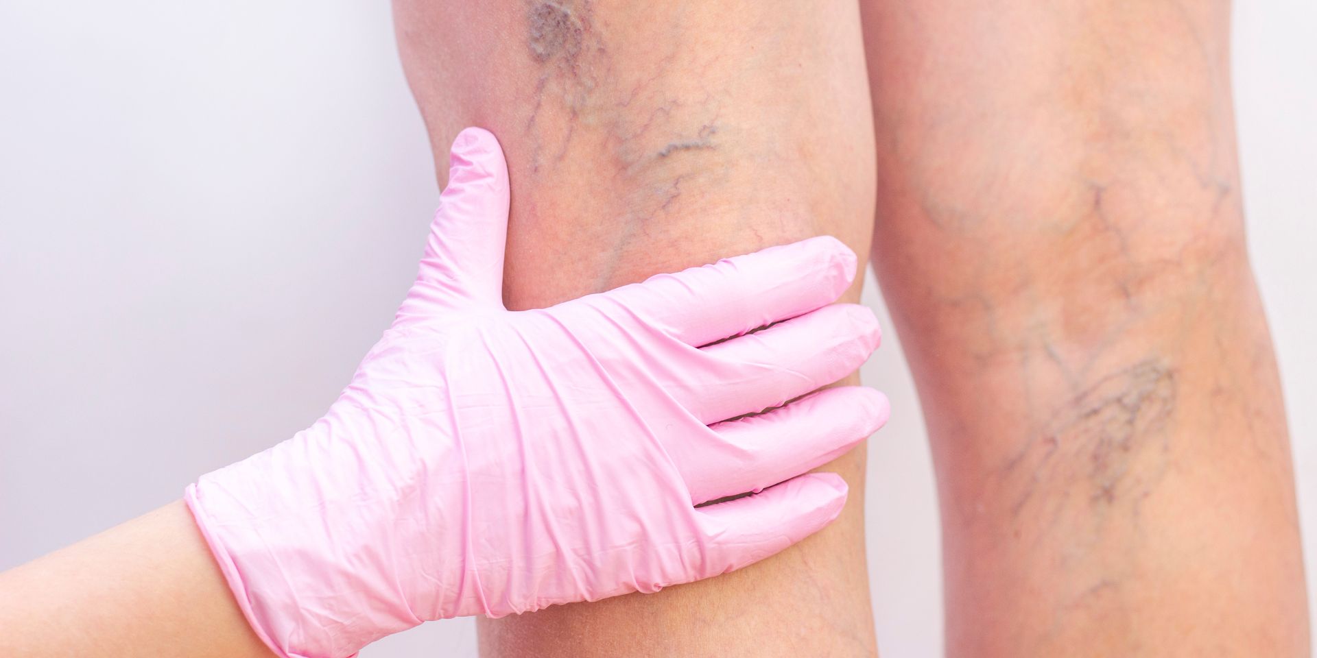 doctor providing a free varicose vein screening