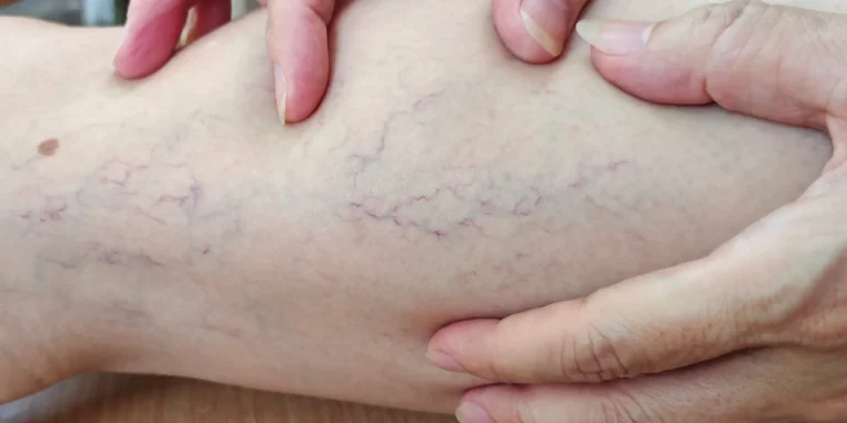 purple veins