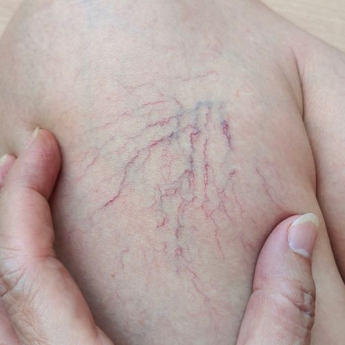 doctor examing a patients chronic venous insufficiency