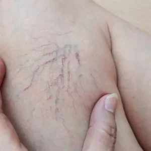 Woman with varicose and spider veins on her leg
