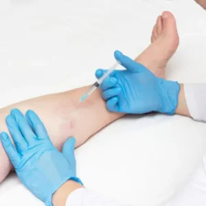 patient undergoing varicose vein treatment