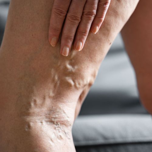 woman examining the varicose veins on the back of her leg