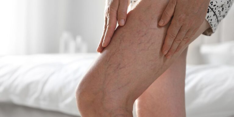 closeup of woman suffering from varicose veins indoors