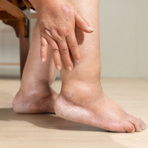 woman with a swollen leg due to chronic venous insufficiency