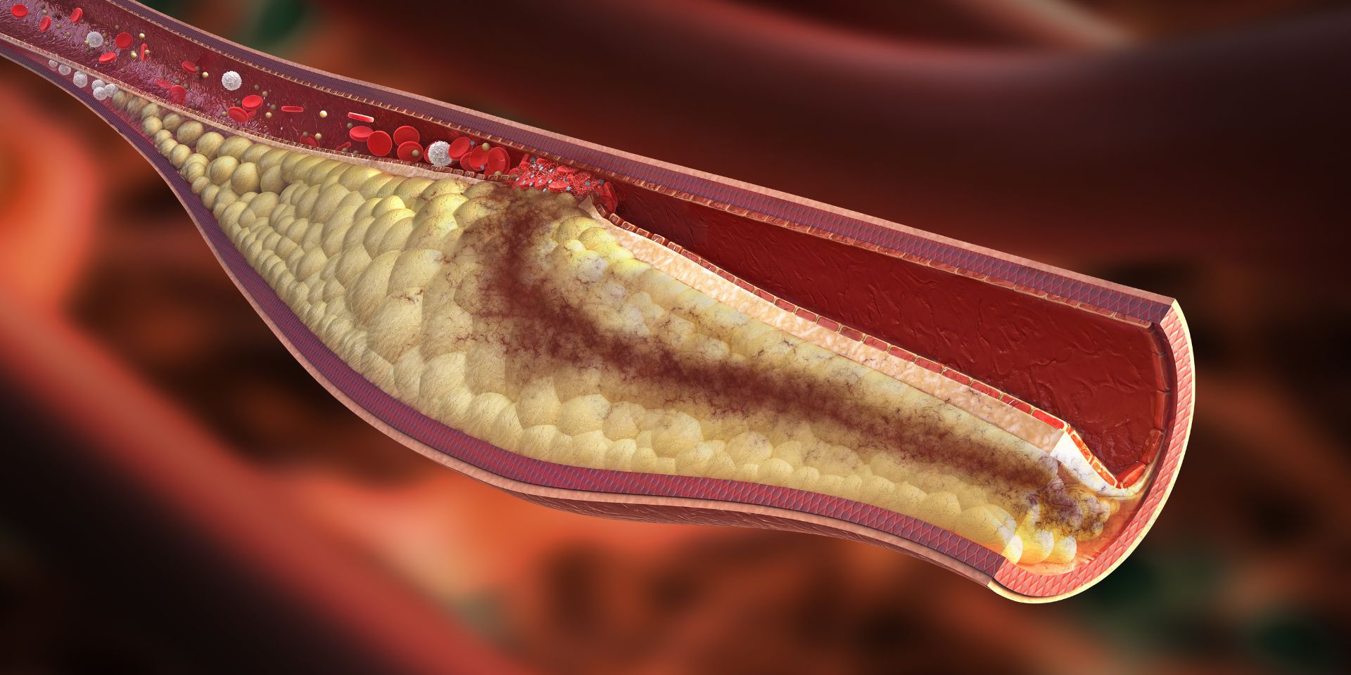 CGI image of plaque clogging an artery