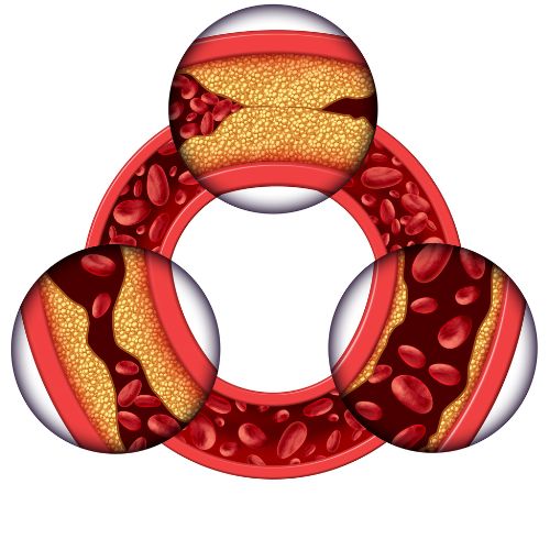 Artistic rendering of the different phases of an artery becoming clogged by plaque