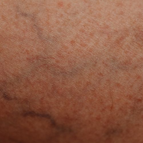 close-up of veins near the surface of a person’s skin