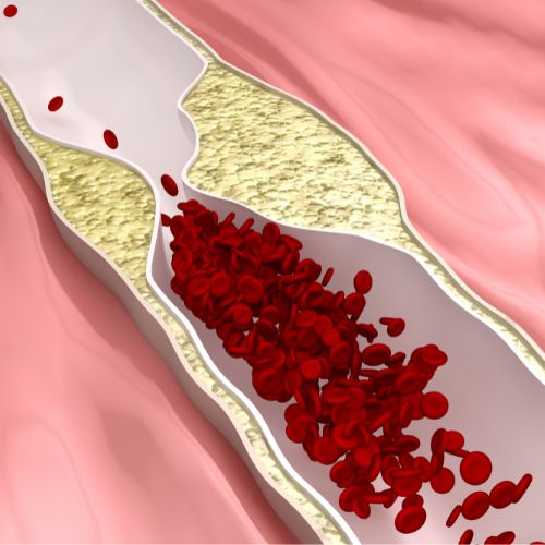 computer-generated rendering of an artery clogged with plaque