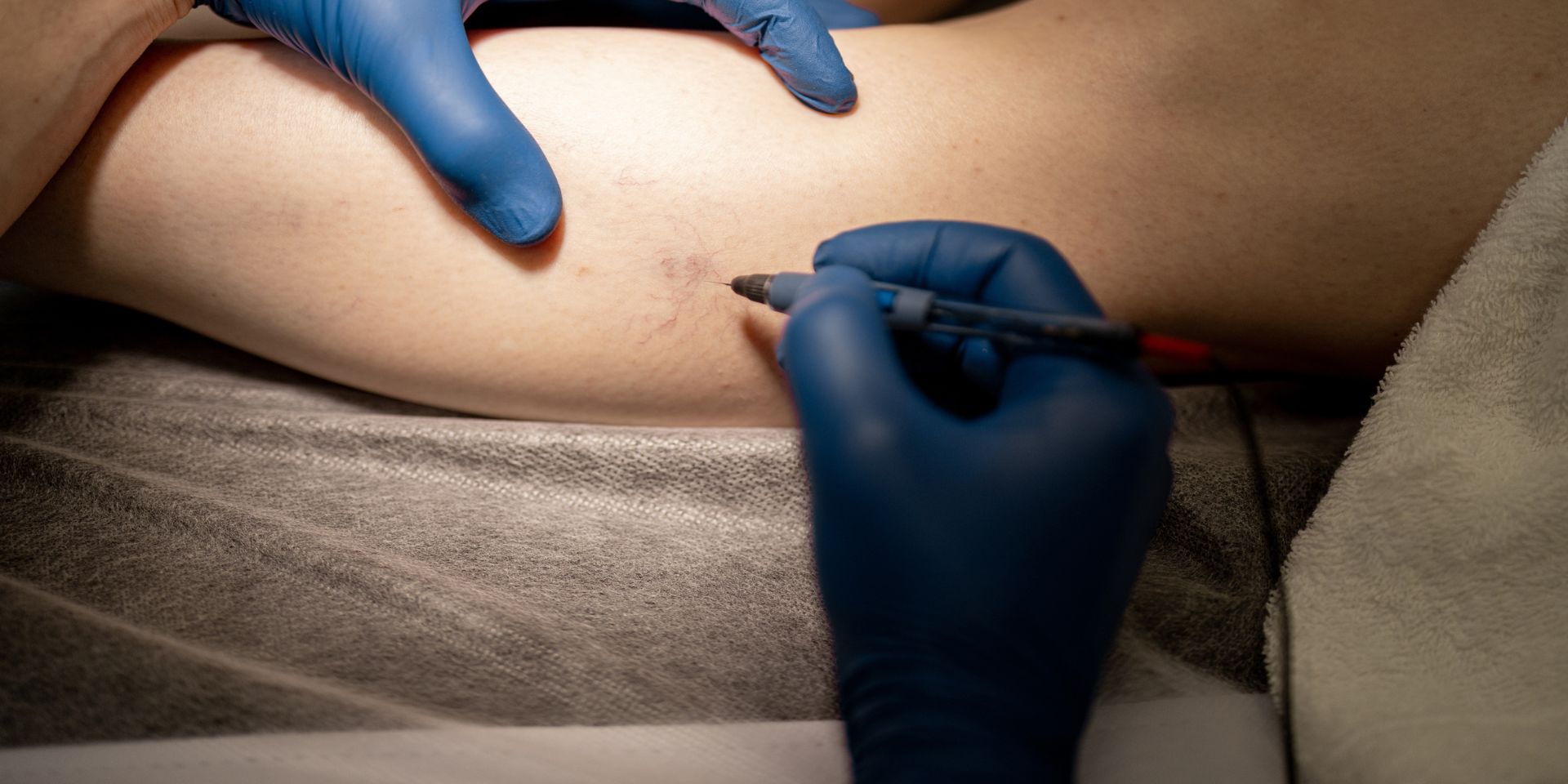 patient having spider veins removed with sclerotherapy