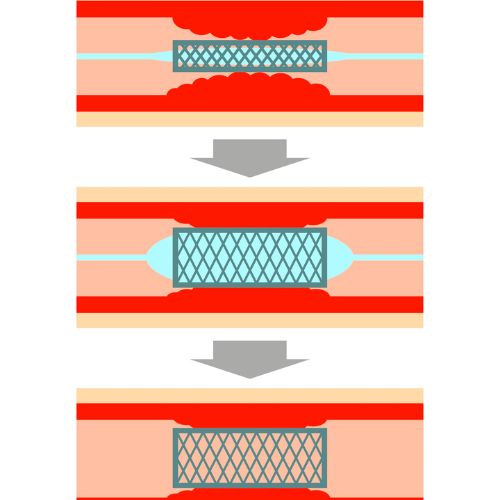 graphic depicting the progression of vascular disease in the vein