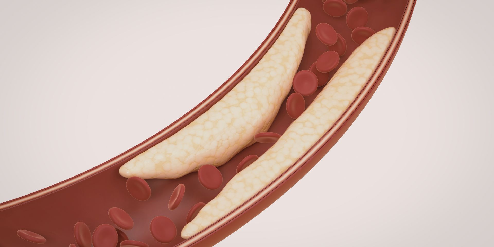 artistic rendering of veins experiencing a blockage, contributing to peripheral artery disease