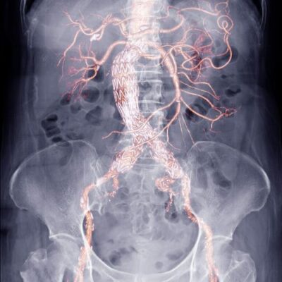 X-ray of abdomen showing abdominal aorta and stent graft
