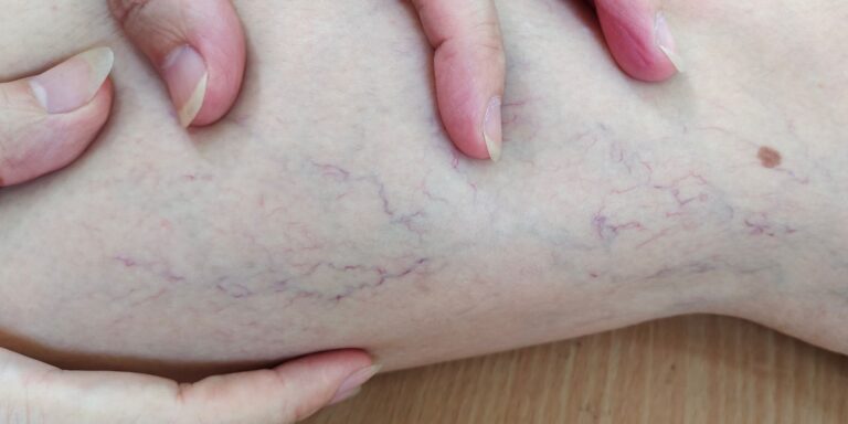 woman examining varicose veins on her leg