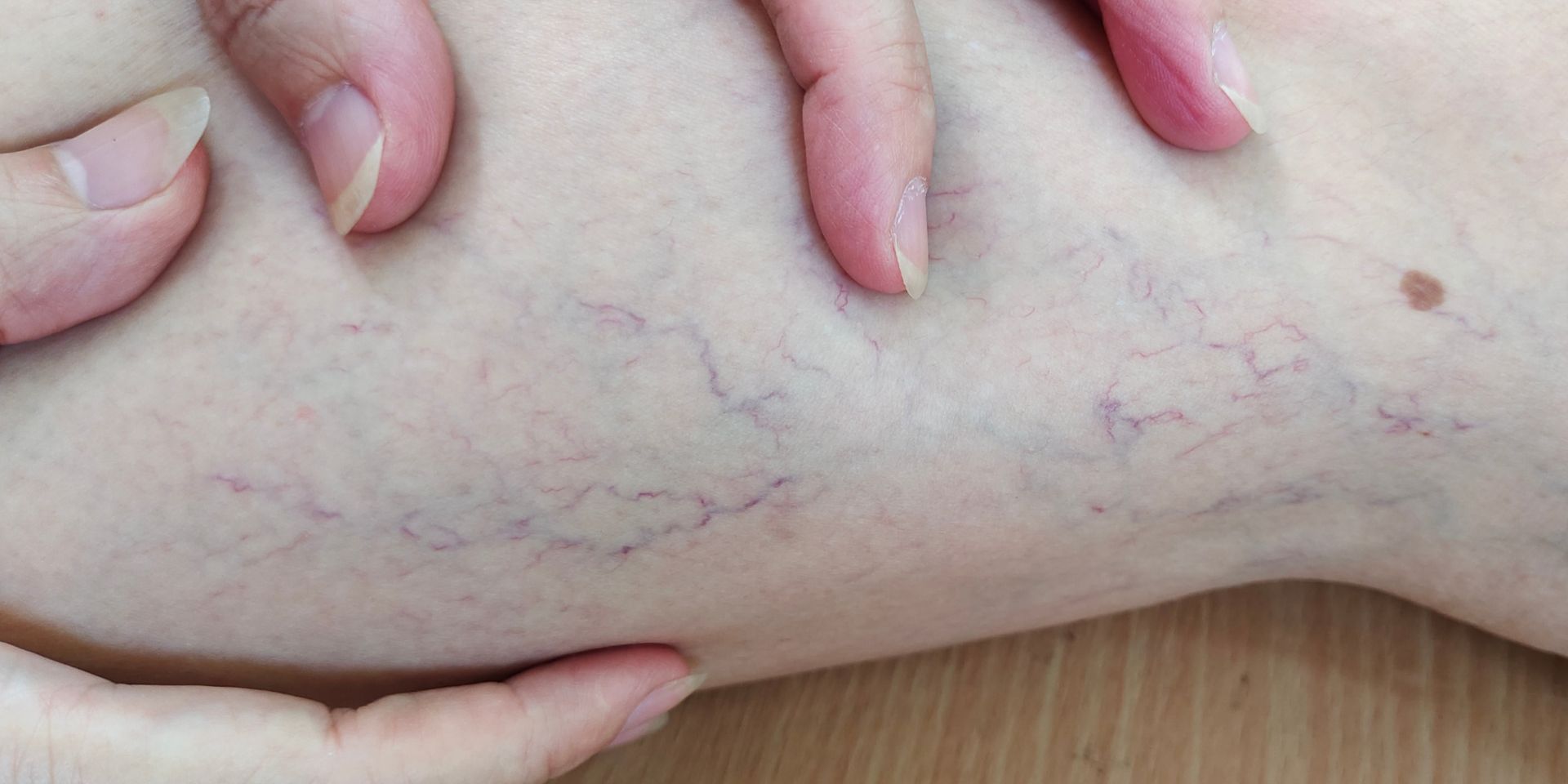 woman examining varicose veins on her leg