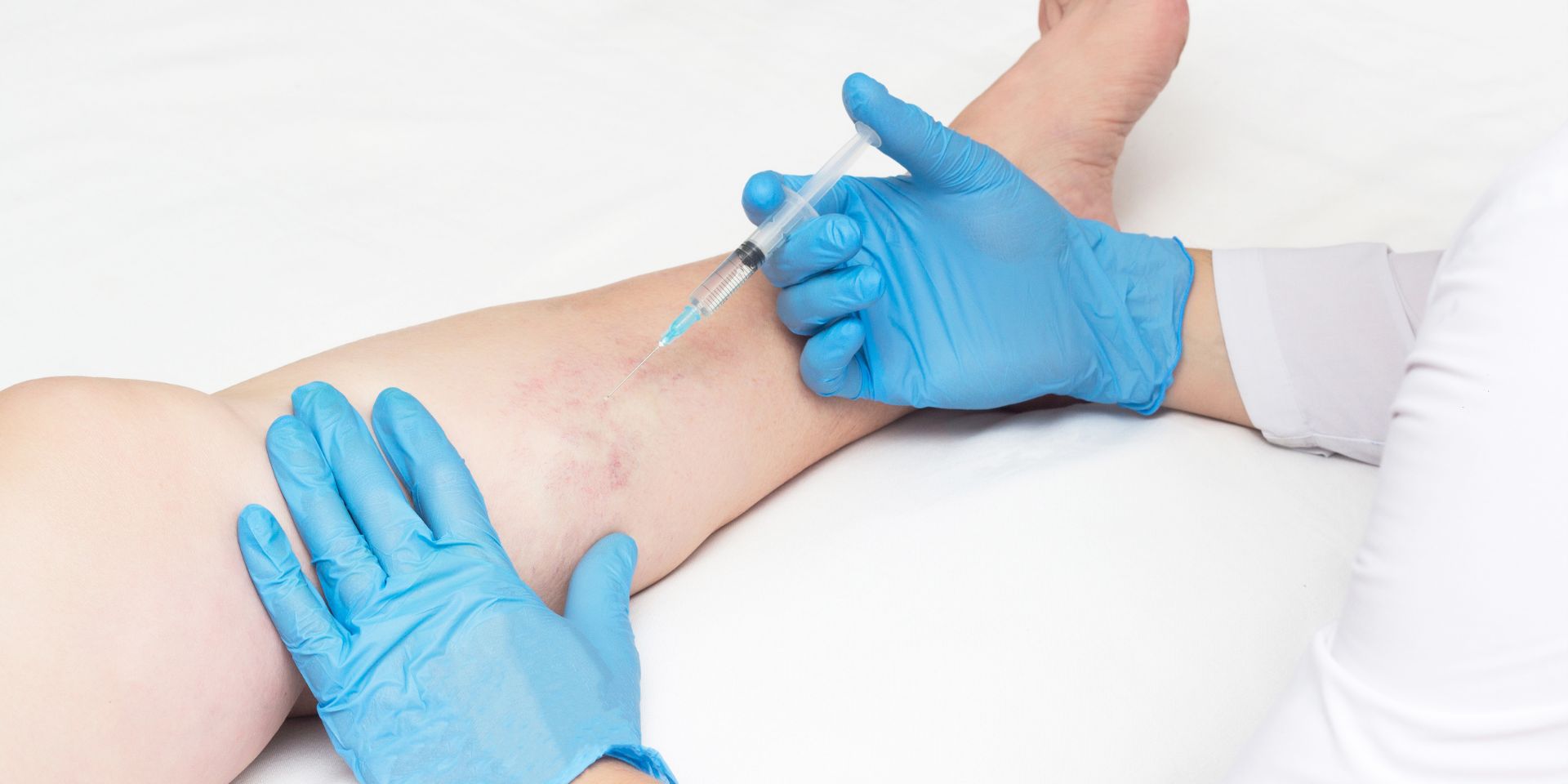 vein doctor treating varicose veins