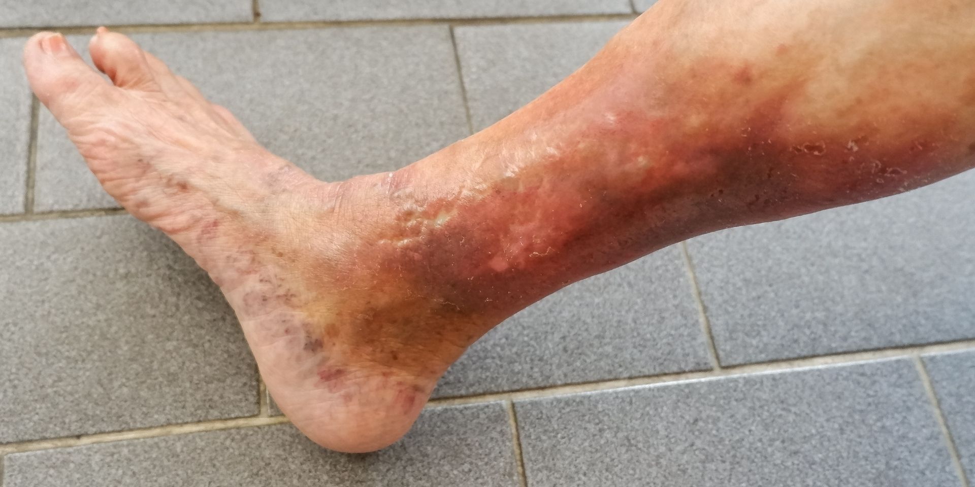 person’s leg with discolored skin due to varicose veins