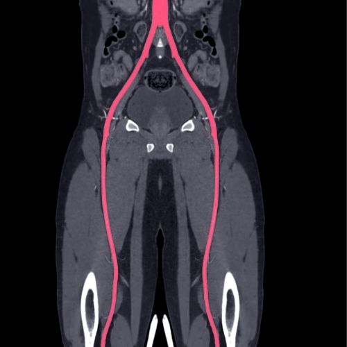 X-ray of a person’s lower body with their arteries highlighted