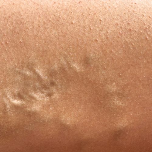 close-up of a varicose vein on a person’s leg