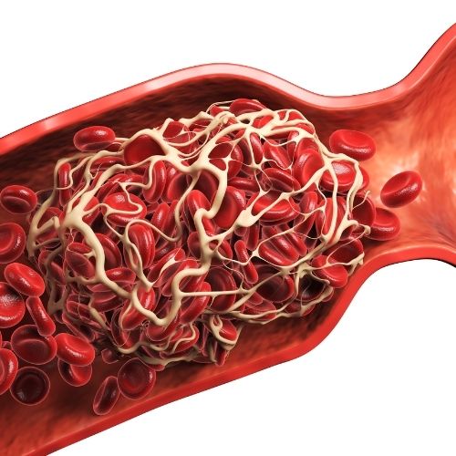artistic rendering of a clogged artery in need of carotid artery surgery